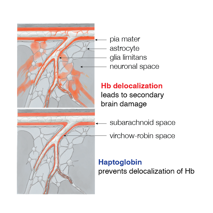 Phathophysiology of Hb delocalization